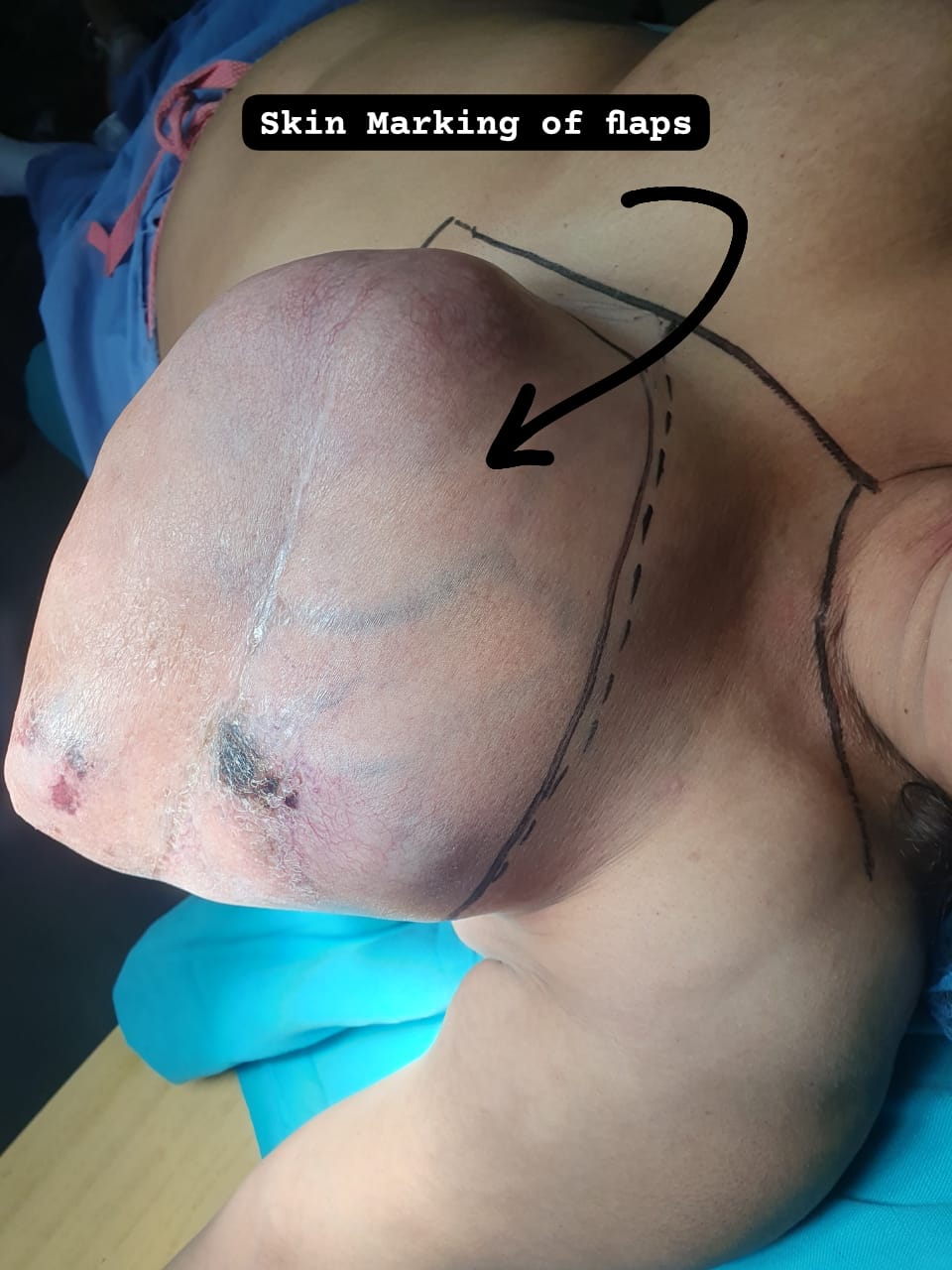Breast Surgery