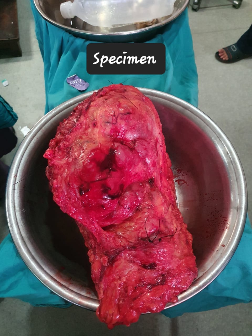 Soft Tissue Tumor Excision